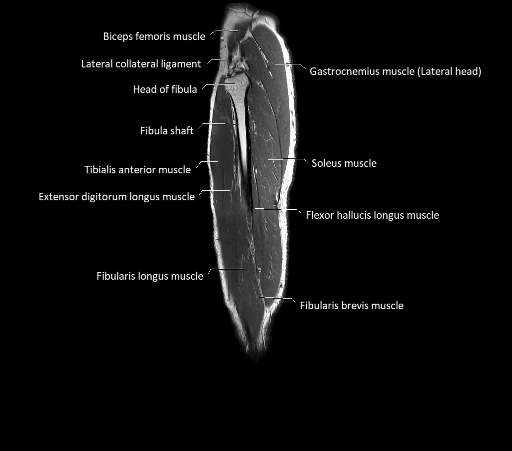 Lower leg sagittal anatomy 3T MRI image 8.webp